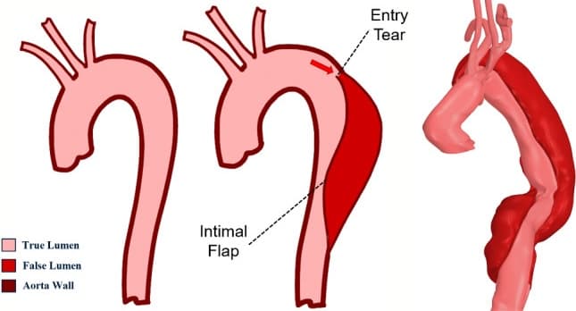 Illustrations of normal and dissected aortic anatomy with a patient-specific dissected aorta, showing true lumen, false lumen, and entry tear
